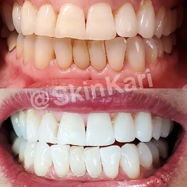 Cosmetic Teeth Whitening 