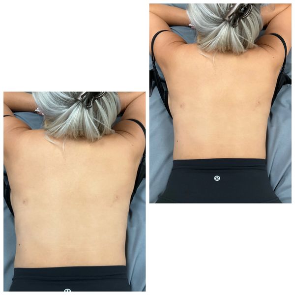 best RF lymphatic drainage near me, Newport Beach