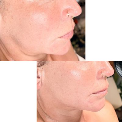 External jaw and cheek sculpting to release facial tension