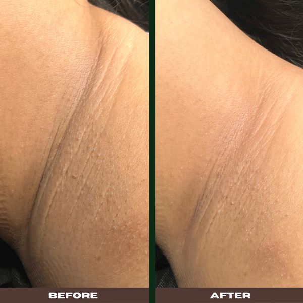 Before and After 1 Underarm Organic Skin Lightening