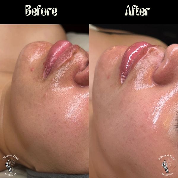 Dermaplaning facial, Dream girl facial. Removing dead skin and peach fuzz.