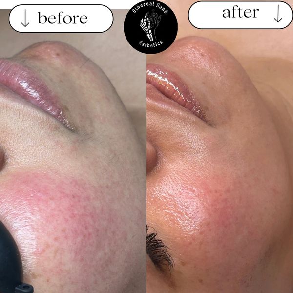Dermaplane facial. Removing dead skin and peach fuzz.Hydrated and calmed skin.