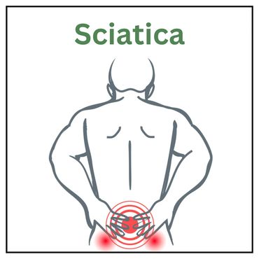 Sciatica, Sciatic Pain , Chiropractor, Chiropractic, Click, Crack, Pop Crunch, Ache, Sharp, Stabbing
