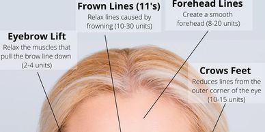 Botox improves frown lines, crows feet and forehead wrinkles for up to 3 months