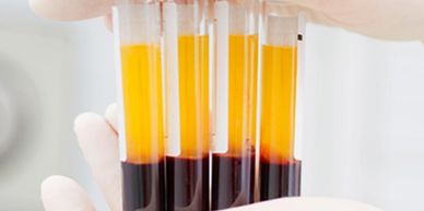 Platelet-rich plasma (PRP) is the liquid gold treatment used to rejuvenate skin