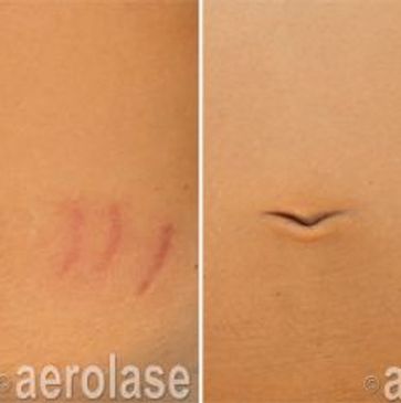 Stretch marks removed with Aerolase Neo Elite laser treatments.