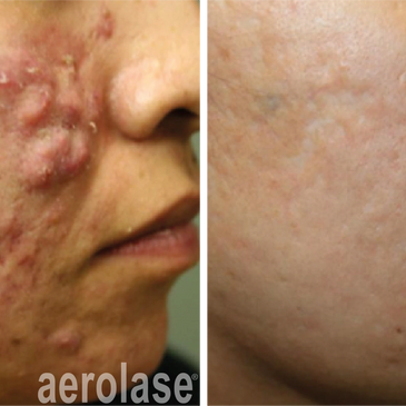 Acne and acne scar treatment with Aerolase Neo Elite