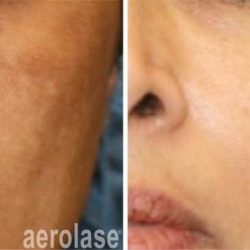 Melasma, hyperpigmentation and dark spots treated with Aerolase Neo Elite laser