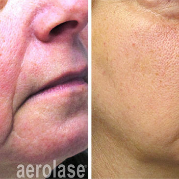 Rosacea and treatment of facial redness with Aerolase Neo Elite.