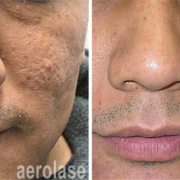 Acne scars and facial rejuvenation with Aerolase Neo Elite Laser treatment