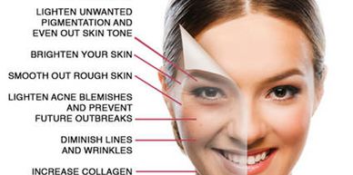 Chemical peels lighten, brighten and smooth out your skin while diminishing lines & wrinkles
