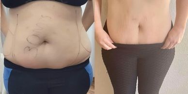 Body contouring tightens skin and reduces your waistline and other problem areas