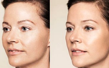 skin booster peelings filler