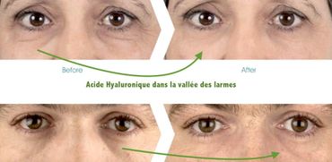 traangootjes fillers