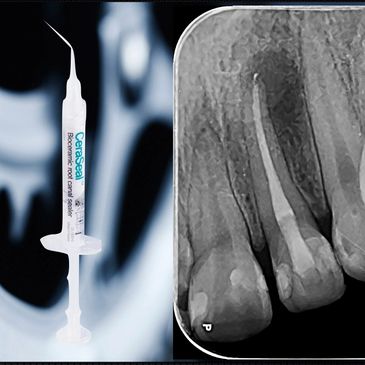Somos especialistas en endodoncia, salvamos dientes