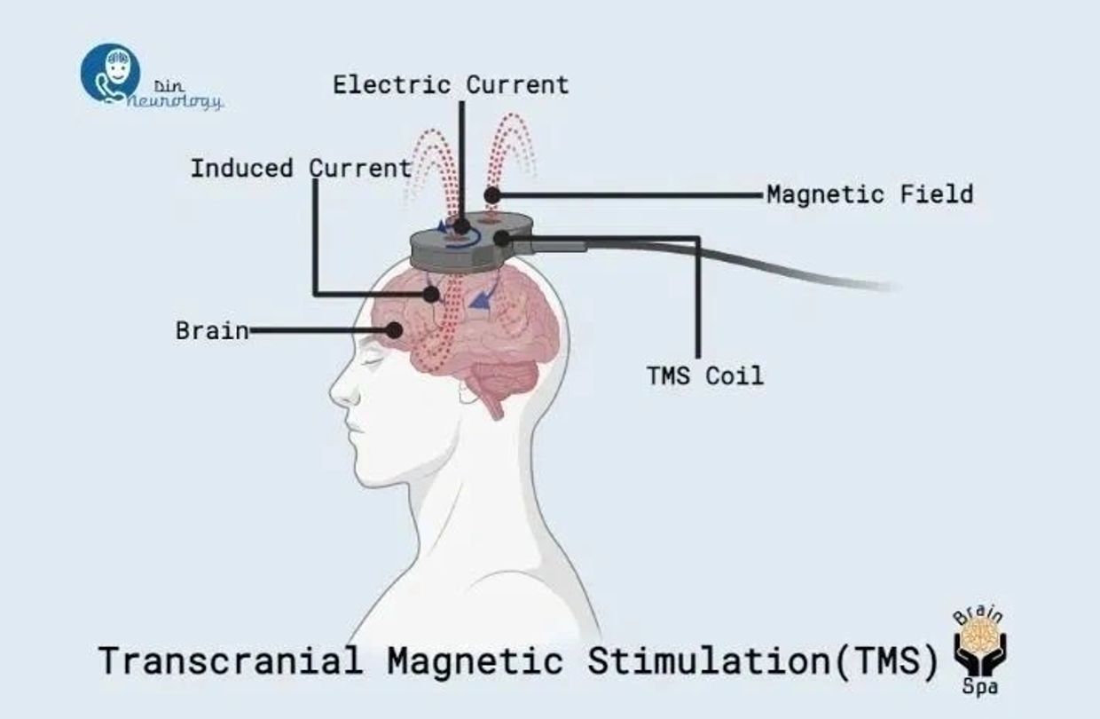 Diagram showing Transcranial Magnetic Stimulation (TMS) affecting the brain with electric and magnetic fields.