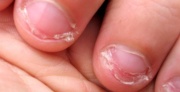 badly bitten nails
