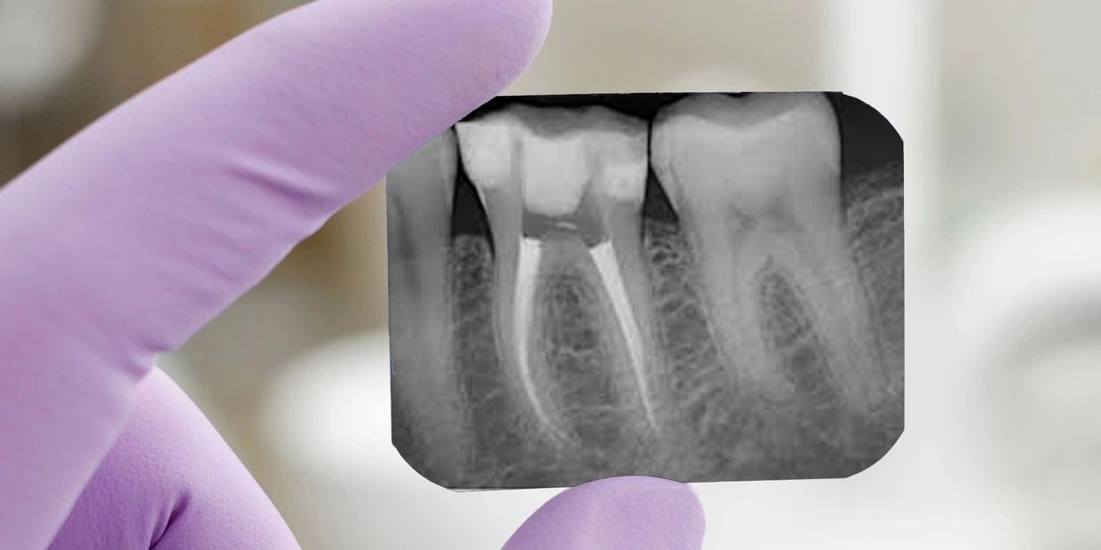Painless single sitting Root Canal Treatment
single sitting Root Canal Treatment
