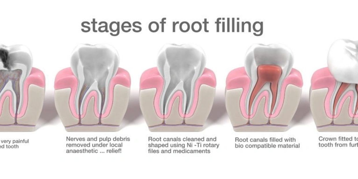 Painless single sitting Root Canal Treatment
single sitting Root Canal Treatment