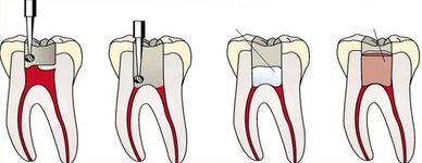pulpotomy,pulpotomy in sridevi dental clinic