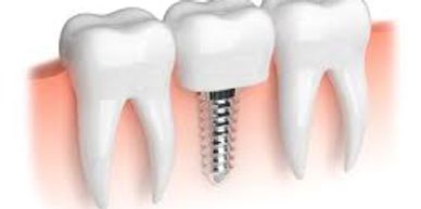 Dental Implants,Single Tooth Implants,Same day Tooth Implants,Multiple Implants