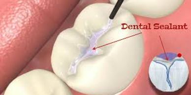 Pit & Fissure Sealant