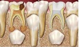 pulpectomy,pulpectomy at sridevi dental clinic,pulpectomy in kakinada,baby root canal treatment