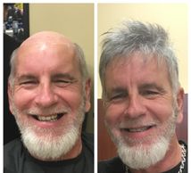 Men’s hair replacement 