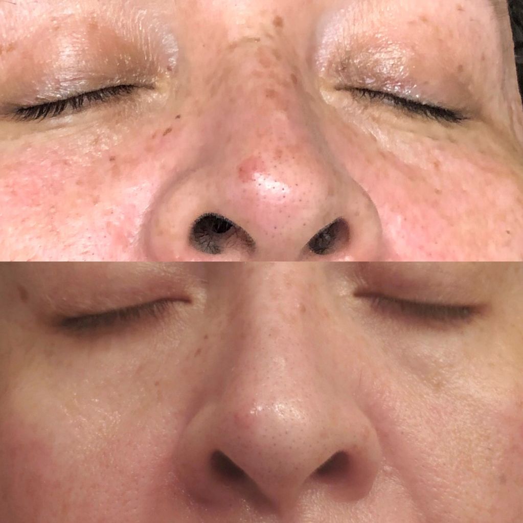 Patient received one Alma Pixel Laser Resurfacing Treatment. 4 day's post treatment.