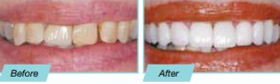 Dental Veneers before and after