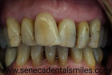 before and after treatment photo with crowns and veneers