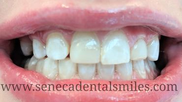 before and after whitening appointment