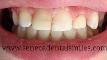 before and after whitening appointment