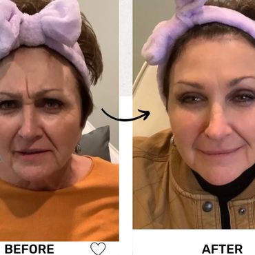 Before and after facial transformation showing smoother skin and reduced wrinkles.