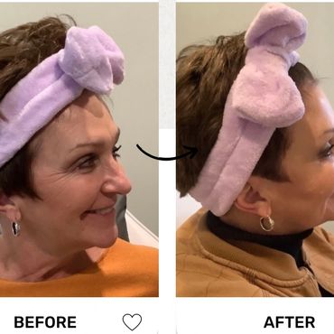 Side-by-side before and after profile photos of a woman showing subtle facial enhancements.