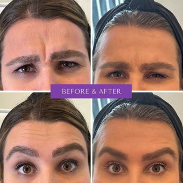 Before and after images show reduced forehead wrinkles and smoother skin.
