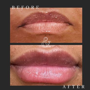 Before and after lip treatment showing improved lip color and texture.