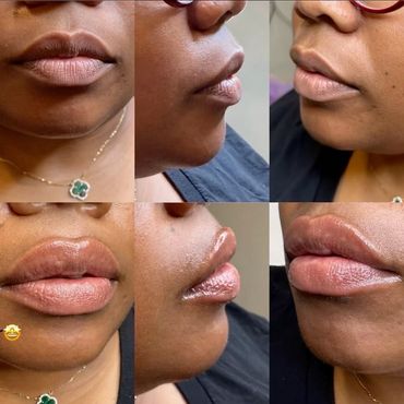 Before and after photos showing lip enhancement results.