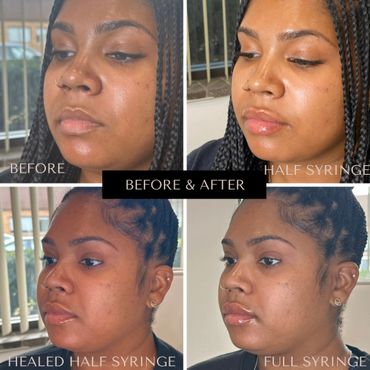 Collage showing before and after lip enhancement with syringes.