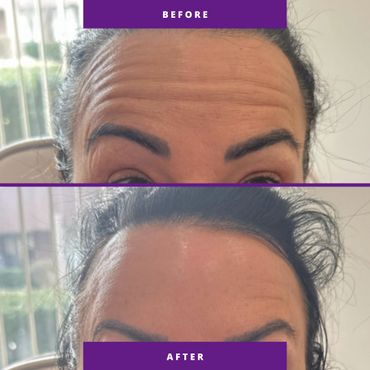 Before and after images showing reduced forehead wrinkles after treatment.