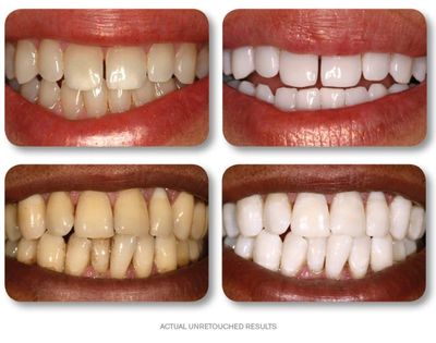 KoR whitening before and after 