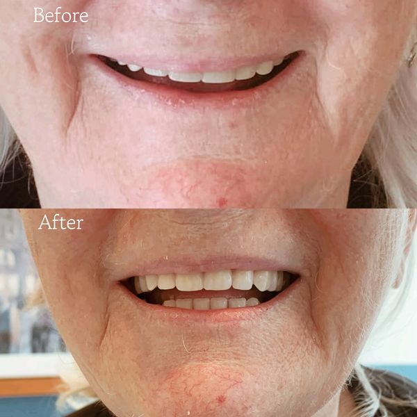 Full upper and lower Denture