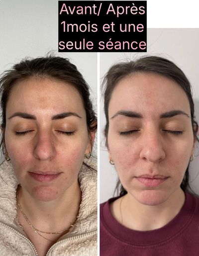 Alexandra Roberge-Gagnon suite à un traitement micro-aiguillage