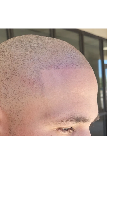Scalp Micropigmentation hairline
