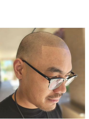 Scalp Micropigmentation after photos