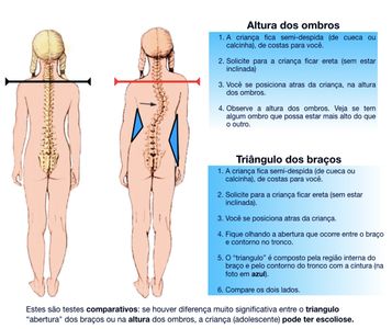 Como identificar escoliose