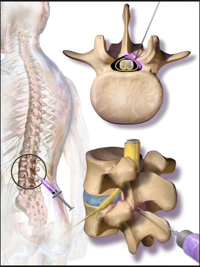 Bloqueio ou Infiltração Epidural na coluna para alívio da dor e inflamação.