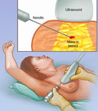 USG GUIDED BIOPSY - investigation for breast cancer