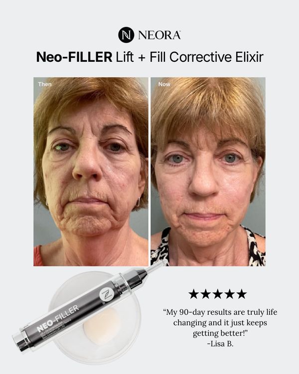 Before and after photos show Neo-FILLER's skin smoothing effects.