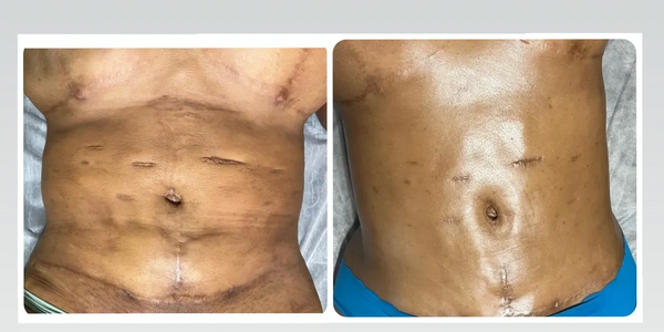 Before and After of patient who underwent liposuction after previous procedures 